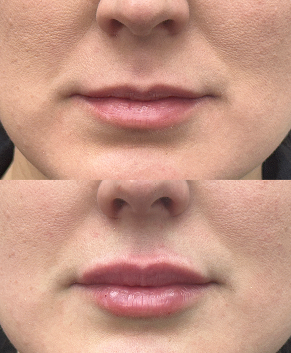 Relleno de labios con ácido hialurónico en Clínica Miranda - Antes y después