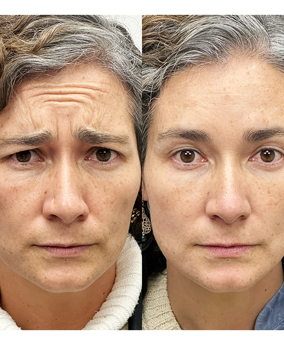 Toxina botulínica (Botox) para rejuvenecimiento facial en Clínica Miranda