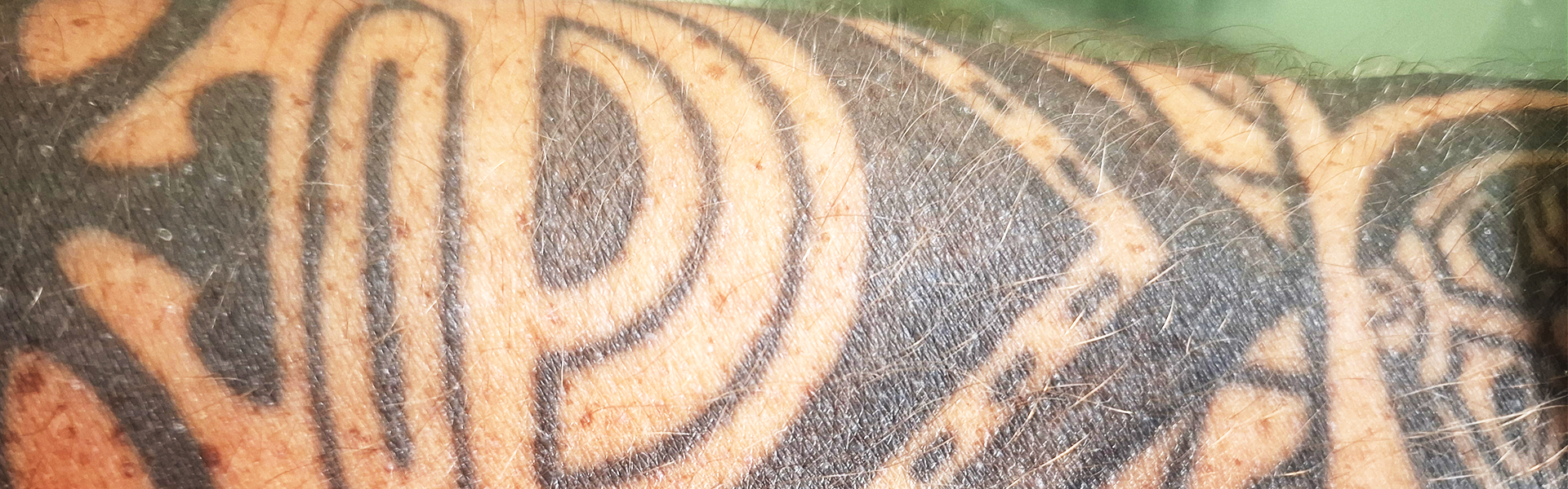 Eliminación de tatuajes con láser en Providencia
