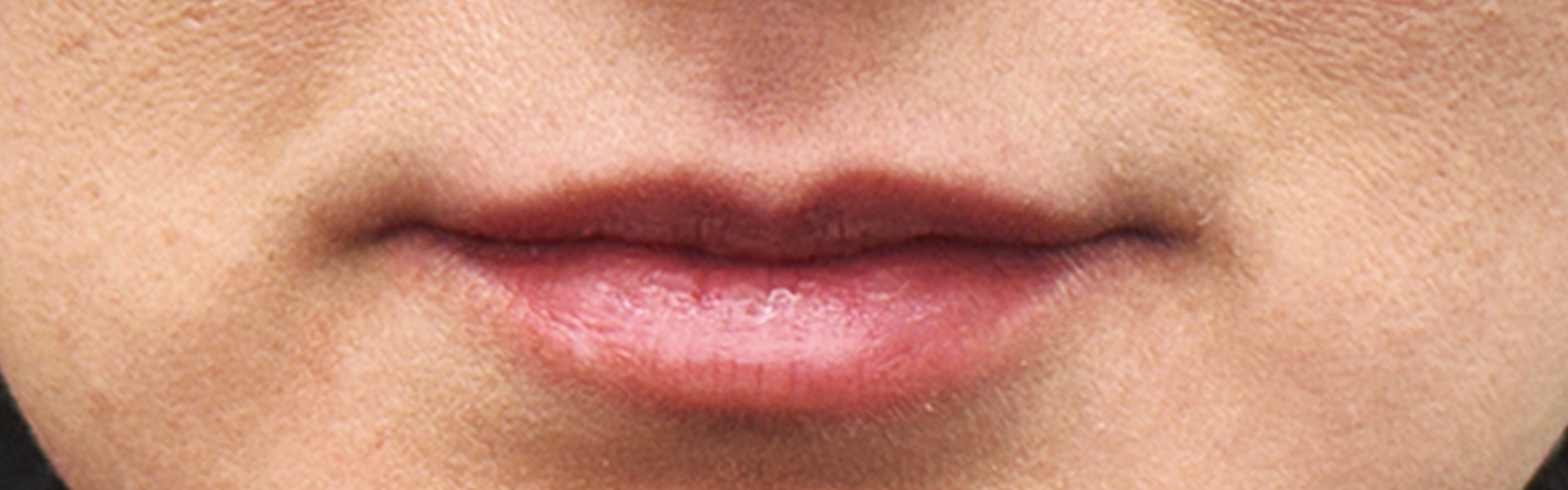 Ácido hialurónico en Santiago - Relleno de labios y ojeras en Providencia
